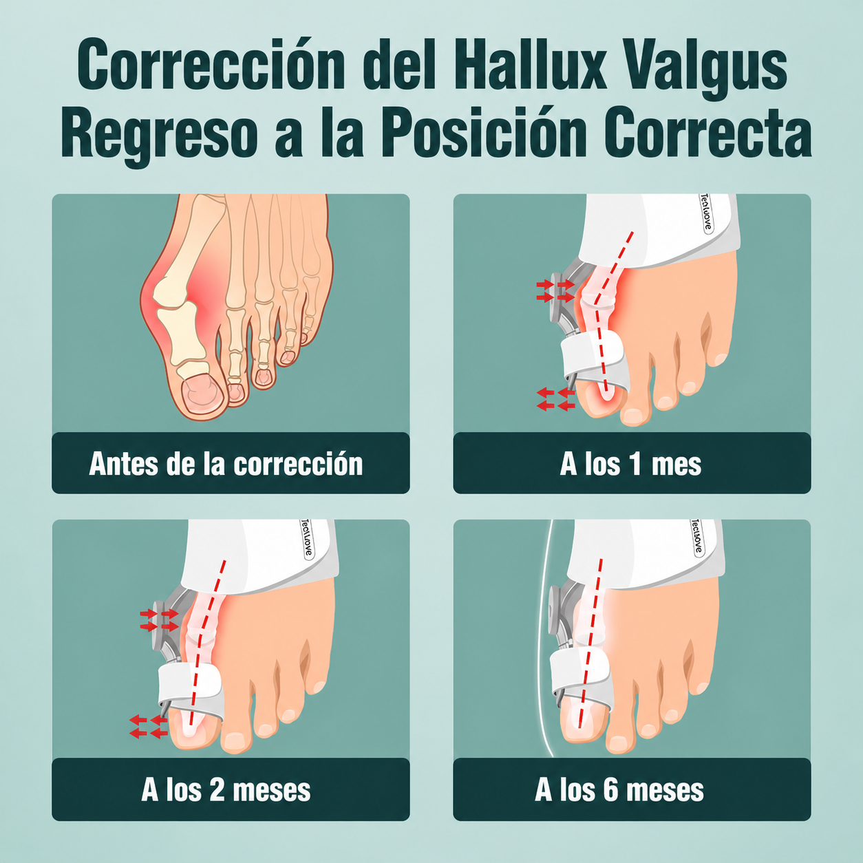 Corrector de Juanetes con Ajustador